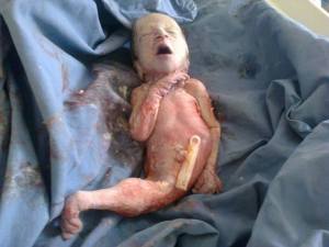 Ein Tarma Damascus bambino nato deforme 21 ospedale di Alzahra